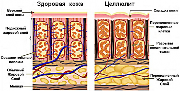 Целлюлит что это такое и откуда он берется Целлюлит что это такое и откуда он берется