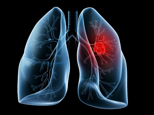 Что нужно знать о раке легких: инструкция по профилактике и скринингу
