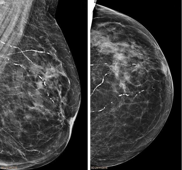 Как подготовиться к маммографии и почему самообследование груди её не заменит