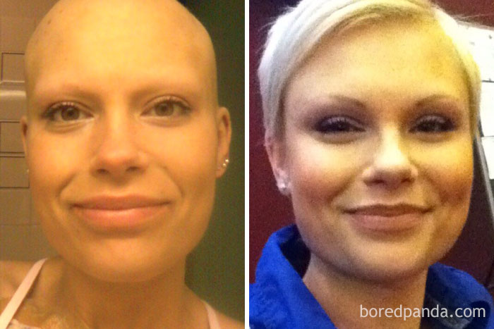 Победили рак сами. Люди до и после химиотерапии. Люди после химиотерапии до и после. Внешность до и после химиотерапии. Лысые девушки до и после.