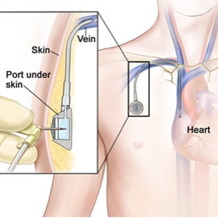 difference between quinton and port a cath placement procedure